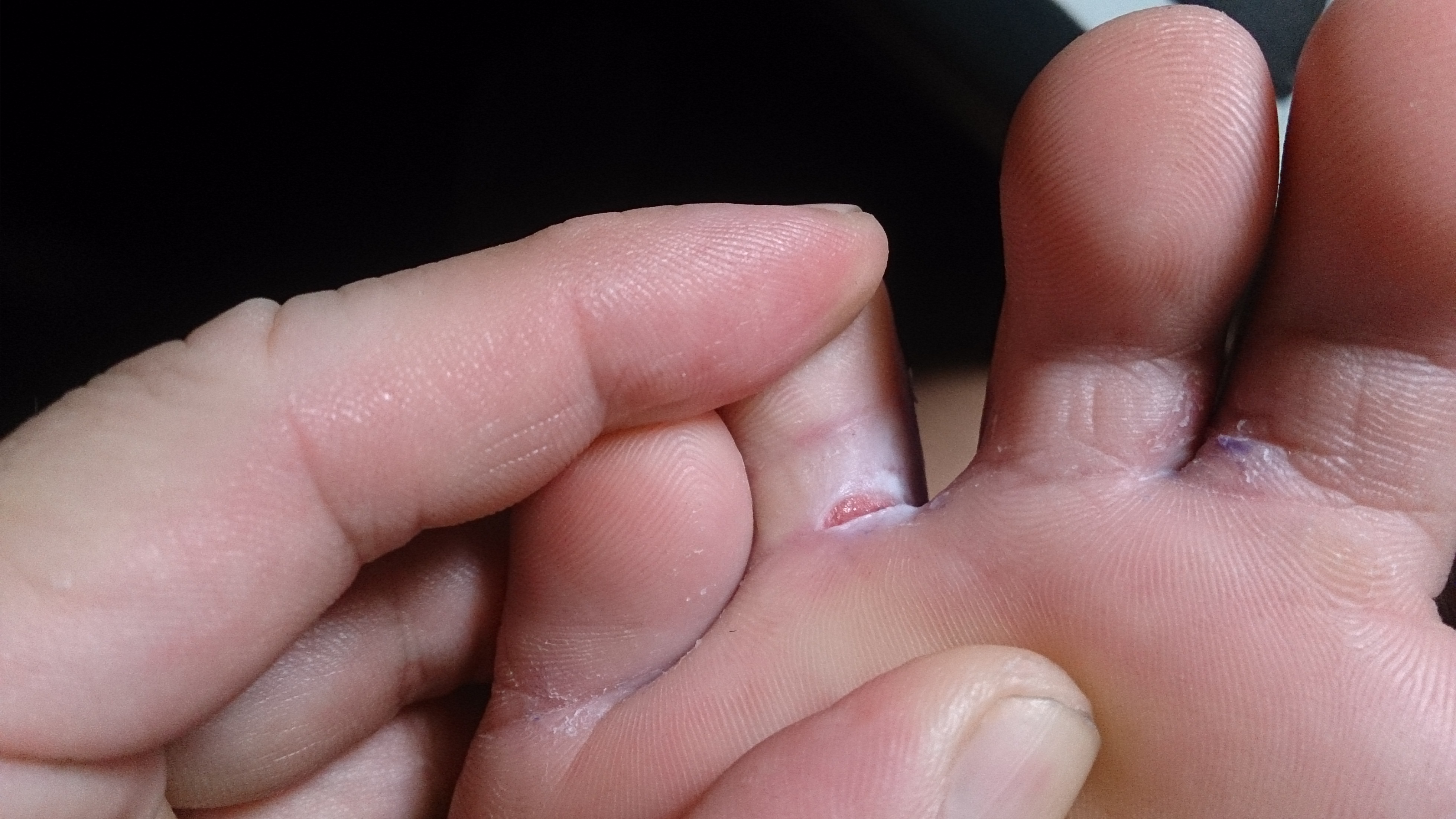 Dry Skin On Toddlers Toes