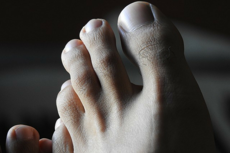 Ingrown Toenail - Foot Health Facts